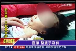 缺四肢,女嬰,產檢,超音波,醫療疏失,沒手腳