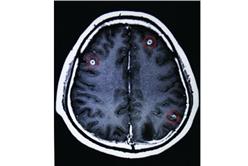寄生蟲(新華網)