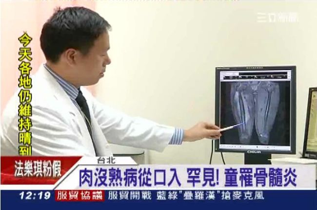 罕見！吃到沒熟肉、童竟罹骨髓炎