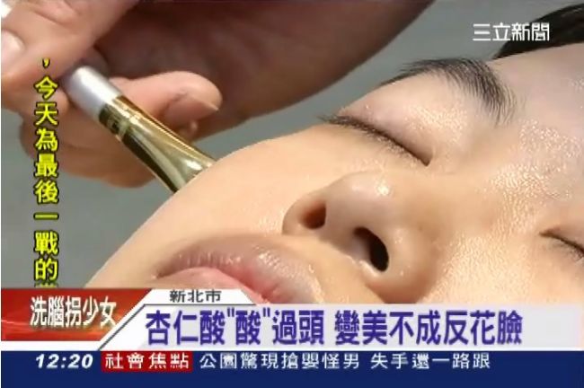 小心！杏仁酸「太酸」煥膚恐致爛臉