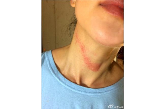 被種草莓？李冰冰脖子紅痕好長一條阿