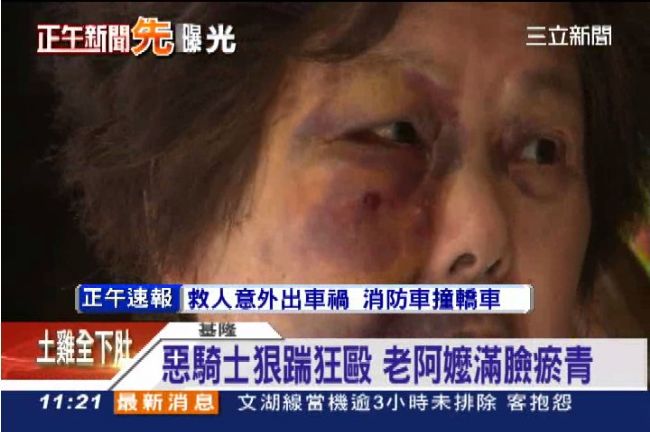 受傷瘀青不理　色素恐沉澱跟一輩子