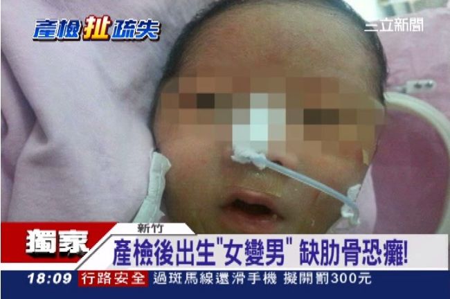 產檢後出生「女變男」　缺肋骨恐癱！