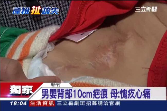 自費1.7萬產檢　兒雙腿癱軟沒知覺