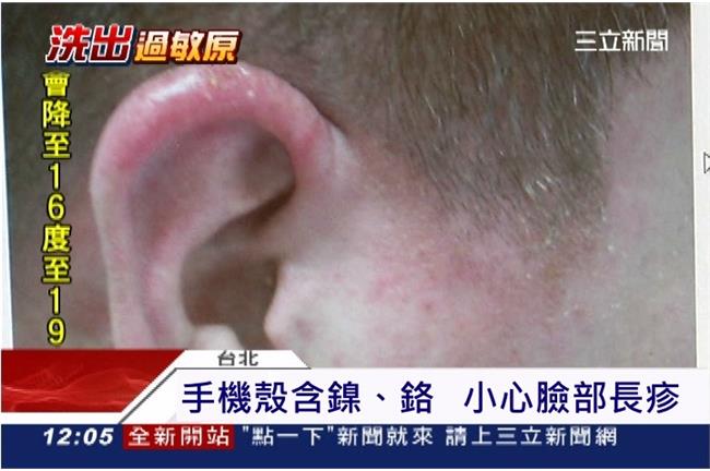 手機外殼含鎳、鉻　小心過敏變爛臉