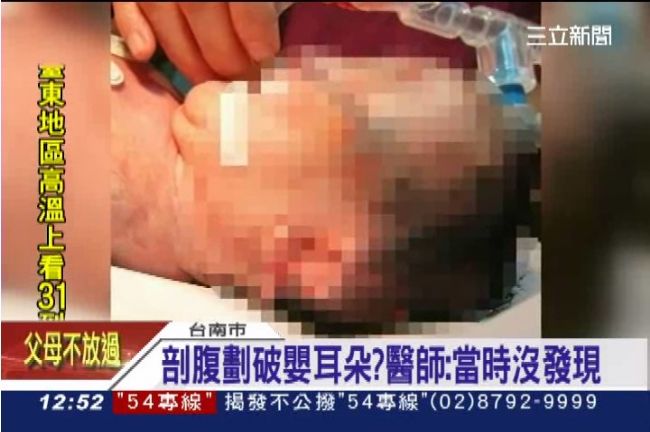 剖腹產竟割破嬰耳朵？母控婦產科疏失