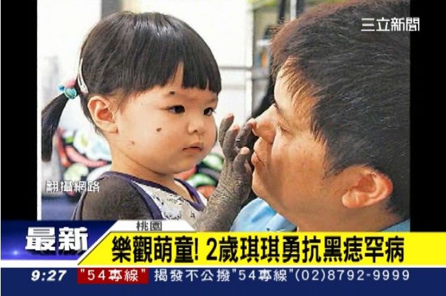 2歲琪琪樂觀力抗黑痣罕病