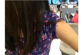 黑痣(攝影／紫色幸運貓)