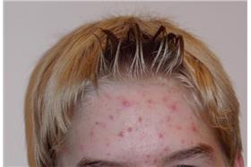 粉刺.青春痘.痘痘（圖／翻攝自WIKI）