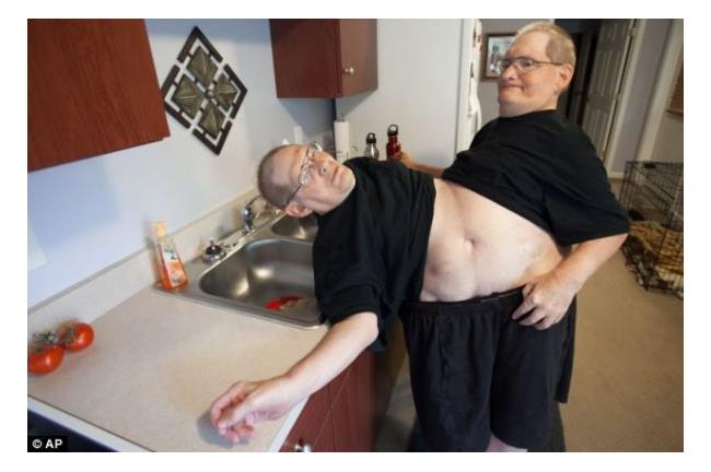 世界上活得最久連體嬰　將滿63歲