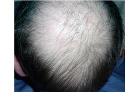 禿頭圖自維基百科