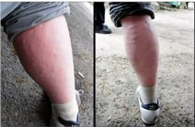 被蚊子叮圖 截圖自youtube