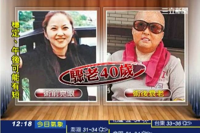 貧血骨髓移植　40歲美女竟變阿嬤