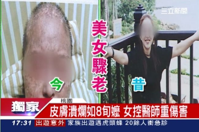 骨髓移植手術　40歲美女如8旬嬤
