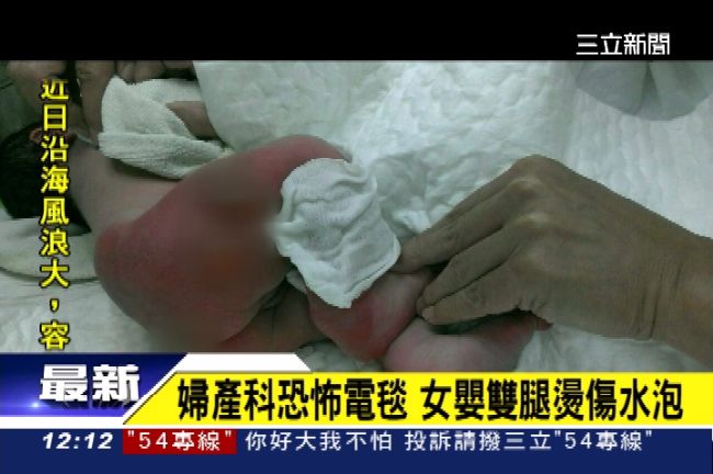女嬰遭二度燙傷　婦產科推給電毯公司