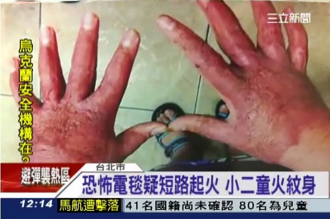 恐怖電毯疑短路起火　可憐男童火紋身