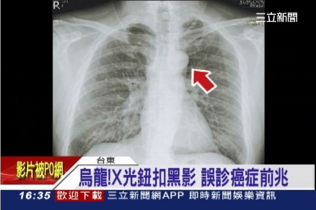 鈕扣黑影誤診肺癌　男寫遺書分財產