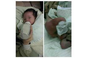 燙傷女嬰－粉絲團