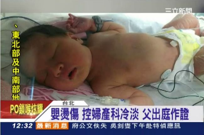 電毯燙傷女嬰動刀　手術順利仍需觀察