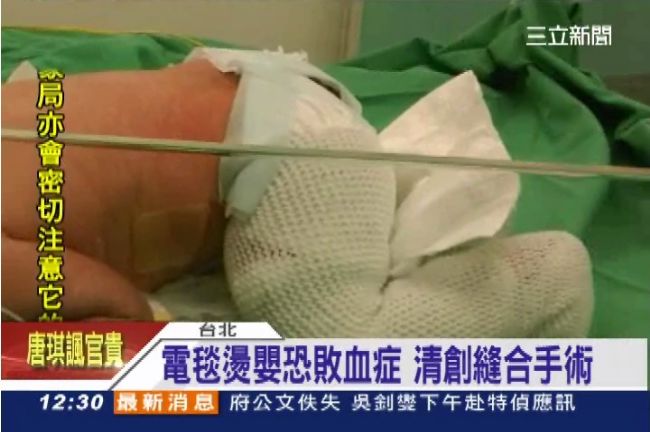 女嬰遭診所電毯燙傷　父母和解撤告