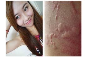 正妹吃鱷魚肉過敏／臉書