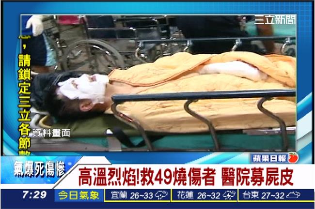 搶救燒燙患　醫院鬧「皮荒」急募屍皮