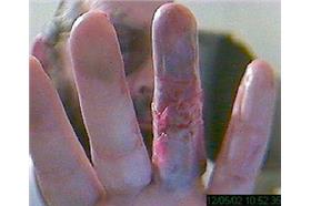 手指被咬斷(flickr:Edward Russell)