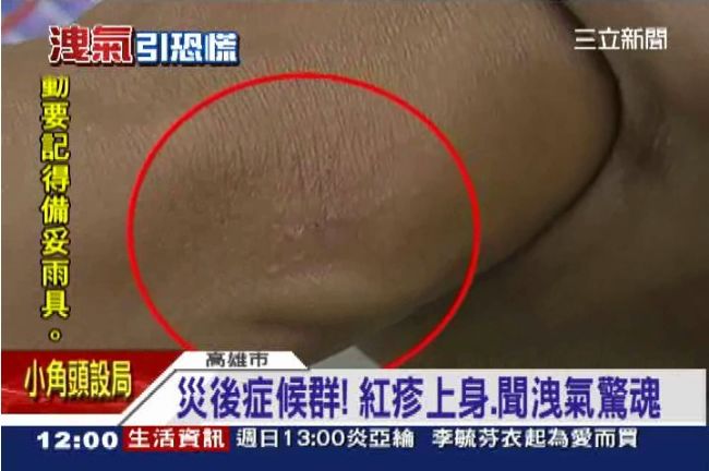 氣爆後遺症！災民紅疹上身又聞洩氣