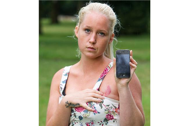 iPhone充電過熱　燒傷女子乳頭