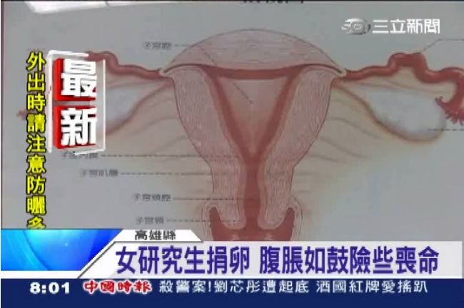 女研究生捐卵　腹脹如鼓險些喪命
