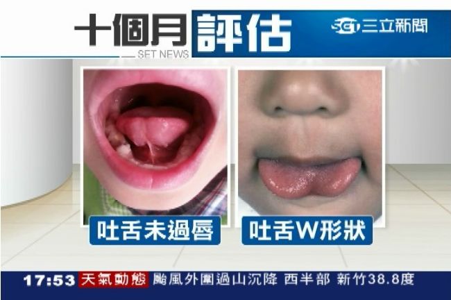 怕大舌頭？女藝人搶帶新生兒剪舌繫帶