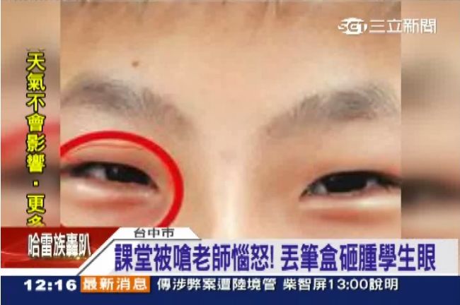 課堂被嗆老師惱怒　丟筆盒砸腫學生眼