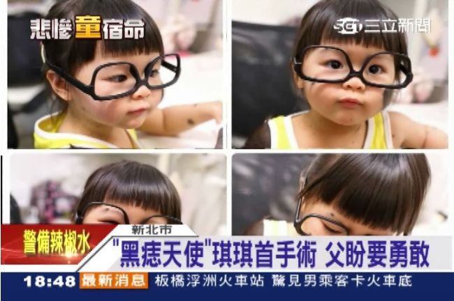 天使琪琪首動刀　消除巨大黑色素痣