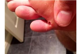 英國男子在非洲沙地 遭沙蚤寄生 腳底竄出上百個蟲卵(翻攝自英國鏡報)