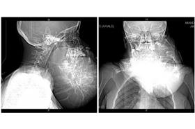 (名家)剛果少女長腫瘤_煎蛋