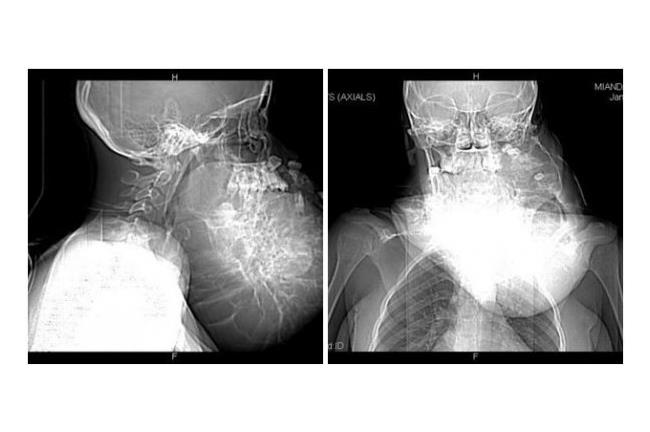 慎入！17歲剛果少女臉長足球大腫瘤
