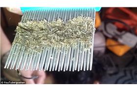 頭蝨/翻攝自《每日郵報》