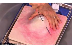 痘痘/翻攝自英國《每日郵報》