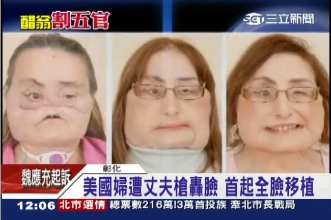 割五官痛苦指數超過10！醫師不忍