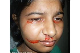 淚血症/翻攝自英國《每日郵報》