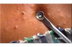 擠痘痘/翻攝自YouTube