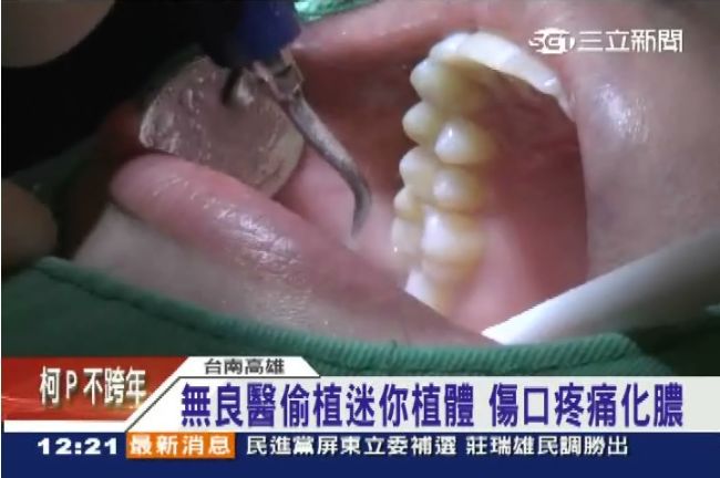 無良！植牙硬擠33顆　重創貴婦外貌