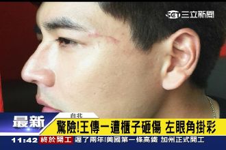 超痛！王傳一遭櫃子砸傷　左眼角掛彩
