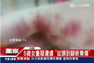 5歲女童疑遭父母虐打　警察見狀鼻酸