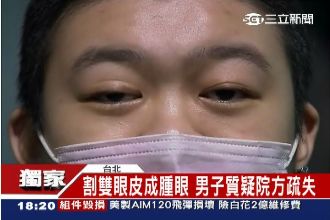 名醫不等於保障！割雙眼皮換大小眼