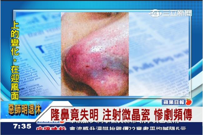 愛美注意！婦人注射微晶瓷隆鼻竟失明