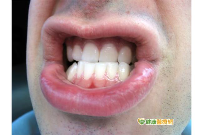 口腔潰瘍原因症狀是？中醫四種治療法