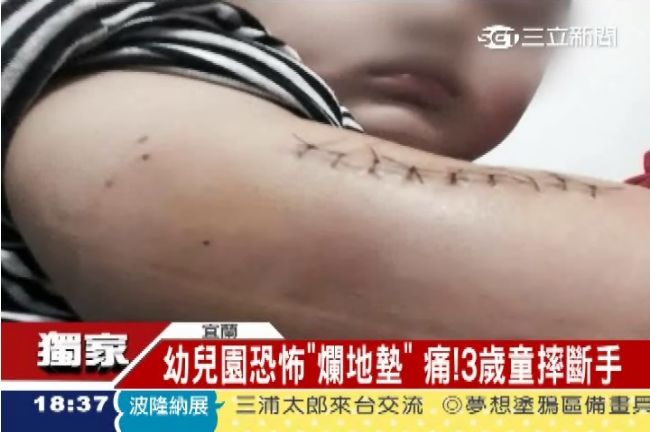 獨／幼兒園恐怖爛地墊　3歲童摔斷手