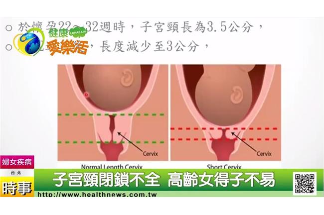 子宮頸閉鎖不全　高齡女得子不易