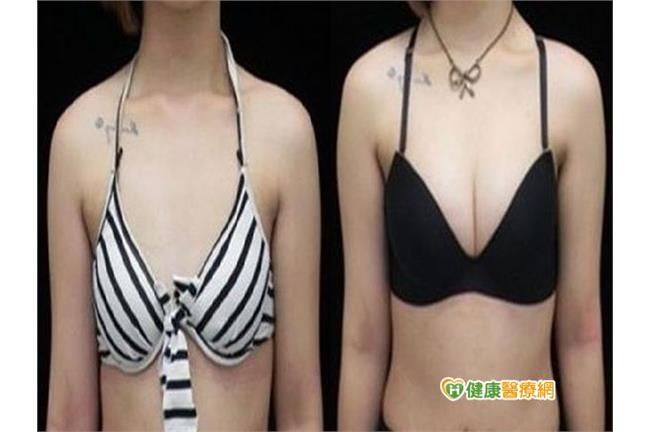 自體脂肪不只能隆乳　還能豐額、豐頰